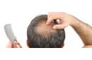 Erkeklerde Saç Yağlanması Nedenleri?