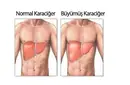 Karaciğer Büyümesi ve Yağlanması