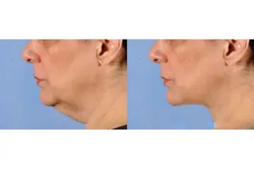 Boyun Yağlanması Belirtileri ve Tedavisi