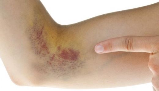 Karaciğer Yağlanması Ciltte Belirtileri Nelerdir?