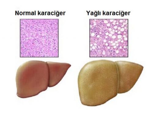 Karaciğer Yağlanması Nasıl Anlaşılır?